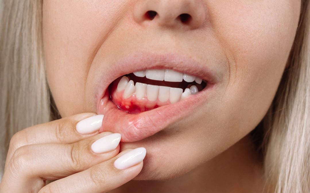 Recessione Gengivale e denti sensibili: Qual è il Collegamento?