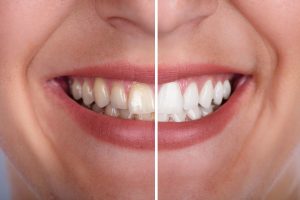 igiene dentale