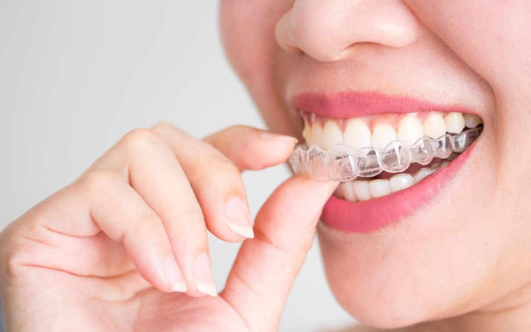 Apparecchio trasparente: allineare i denti da adulti con discrezione